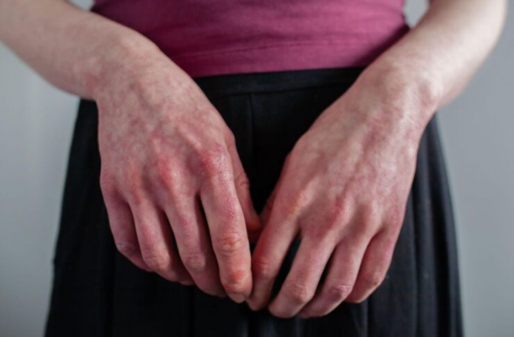 Овој знак на кожата може да укажува на сериозен срцев проблем